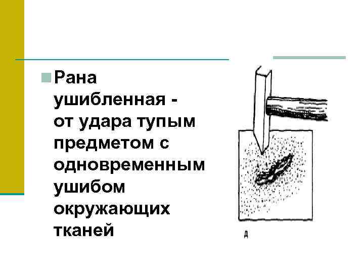 n Рана ушибленная - от удара тупым предметом с одновременным ушибом окружающих тканей 