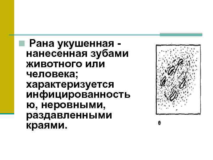 n Рана укушенная - нанесенная зубами животного или человека; характеризуется инфицированность ю, неровными, раздавленными