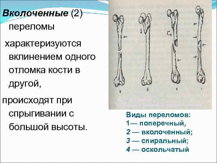 Уровень кость. Поперечный перелом с вклинением отломков. Вколоченный перелом кости. Виды переломов вколоченный.