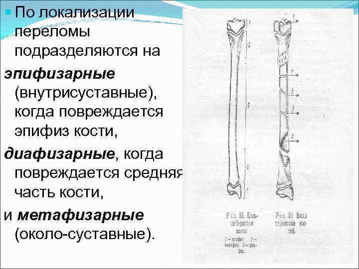 Диафизарный перелом