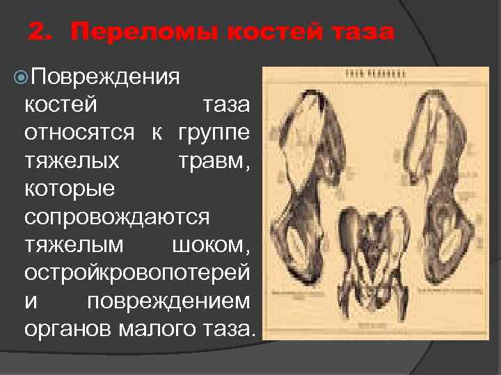 2. Переломы костей таза Повреждения костей таза относятся к группе тяжелых травм, которые сопровождаются