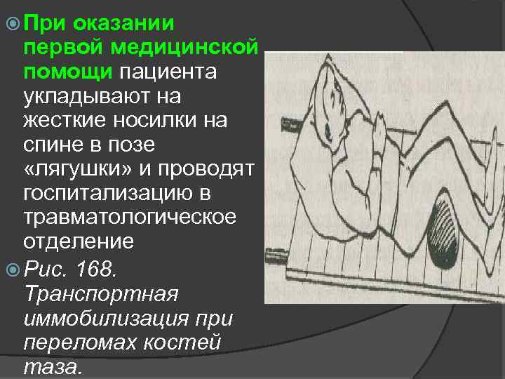  При оказании первой медицинской помощи пациента укладывают на жесткие носилки на спине в