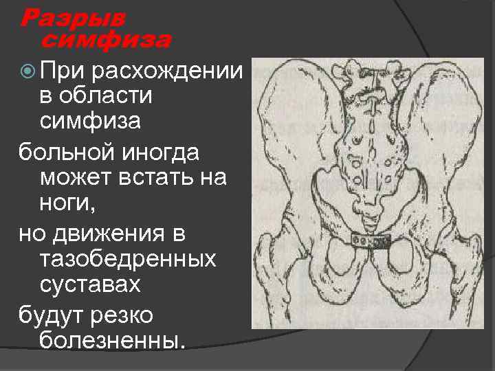 Разрыв симфиза При расхождении в области симфиза больной иногда может встать на ноги, но