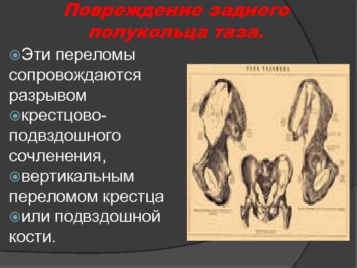 Повреждение заднего полукольца таза. Эти переломы сопровождаются разрывом крестцовоподвздошного сочленения, вертикальным переломом крестца или