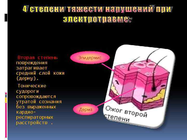 4 степени тяжести нарушений при электротравме: Вторая степень повреждения затрагивает средний слой кожи (дерму).