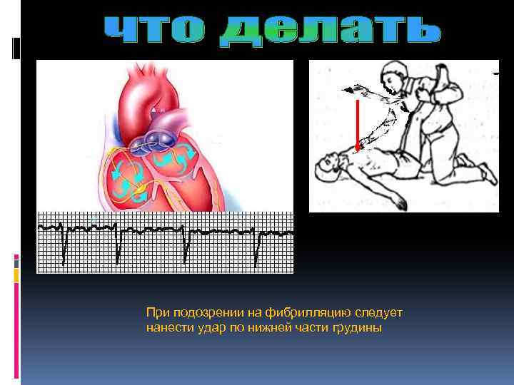 При подозрении на фибрилляцию следует нанести удар по нижней части грудины 