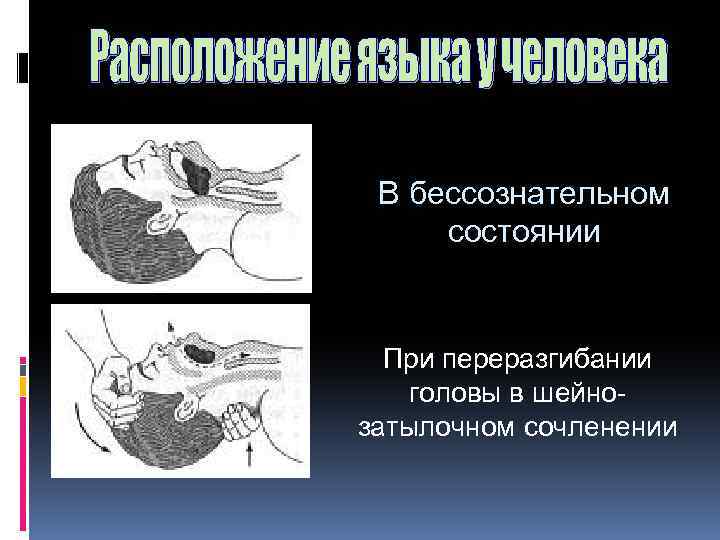 В бессознательном состоянии При переразгибании головы в шейнозатылочном сочленении 