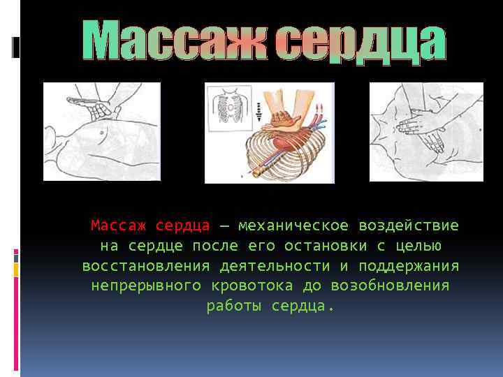  Массаж сердца — механическое воздействие на сердце после его остановки с целью восстановления