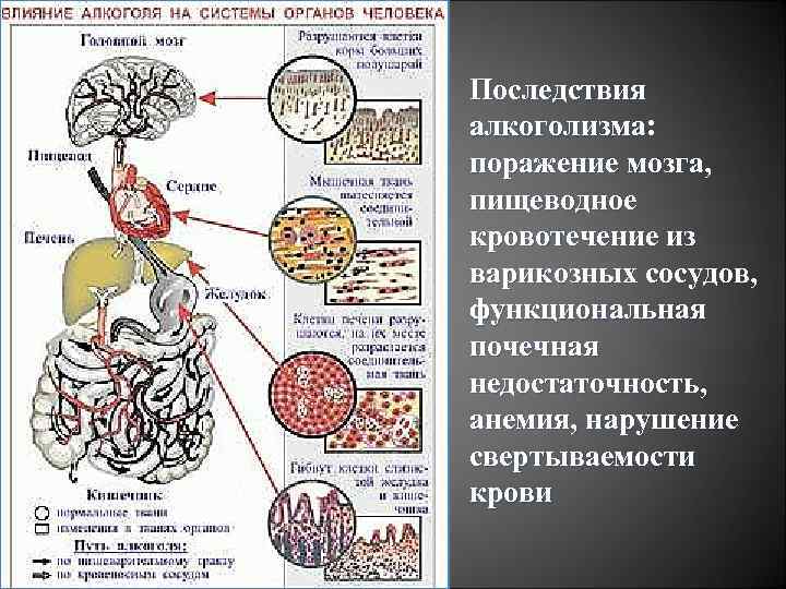 Последствия алкоголизма: поражение мозга, пищеводное кровотечение из варикозных сосудов, функциональная почечная недостаточность, анемия, нарушение