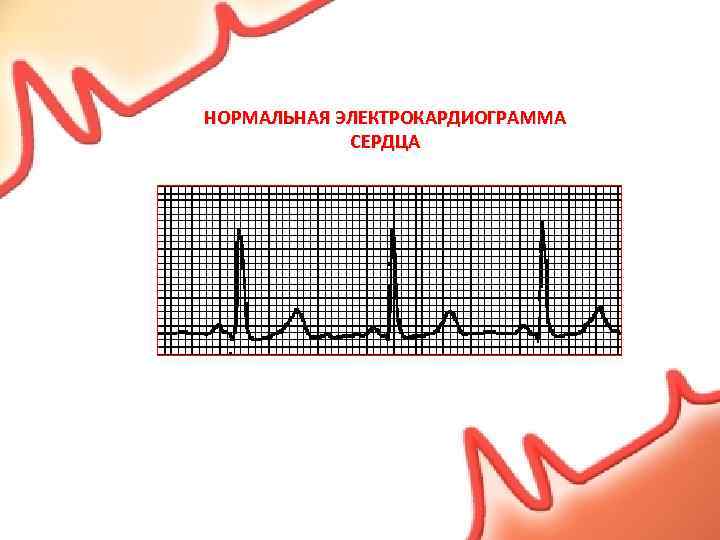 НОРМАЛЬНАЯ ЭЛЕКТРОКАРДИОГРАММА СЕРДЦА 
