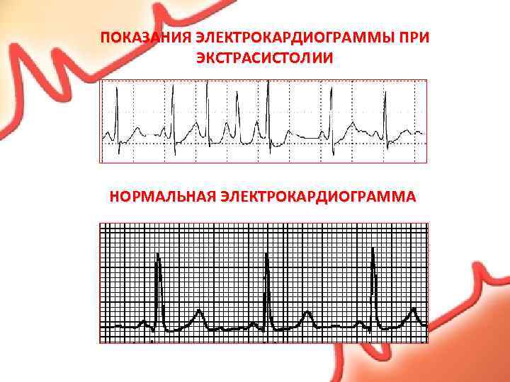 ПОКАЗАНИЯ ЭЛЕКТРОКАРДИОГРАММЫ ПРИ ЭКСТРАСИСТОЛИИ НОРМАЛЬНАЯ ЭЛЕКТРОКАРДИОГРАММА 