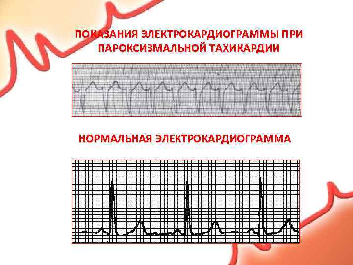 ПОКАЗАНИЯ ЭЛЕКТРОКАРДИОГРАММЫ ПРИ ПАРОКСИЗМАЛЬНОЙ ТАХИКАРДИИ НОРМАЛЬНАЯ ЭЛЕКТРОКАРДИОГРАММА 