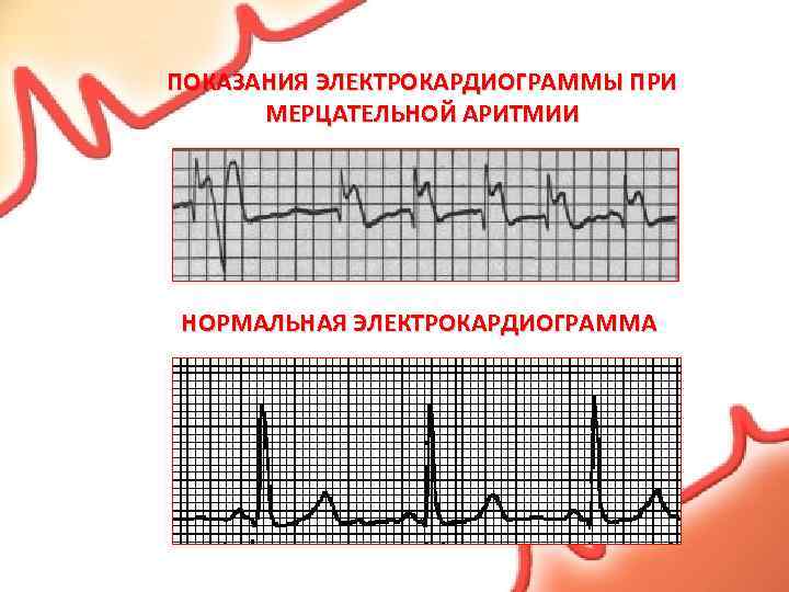 ПОКАЗАНИЯ ЭЛЕКТРОКАРДИОГРАММЫ ПРИ МЕРЦАТЕЛЬНОЙ АРИТМИИ НОРМАЛЬНАЯ ЭЛЕКТРОКАРДИОГРАММА 
