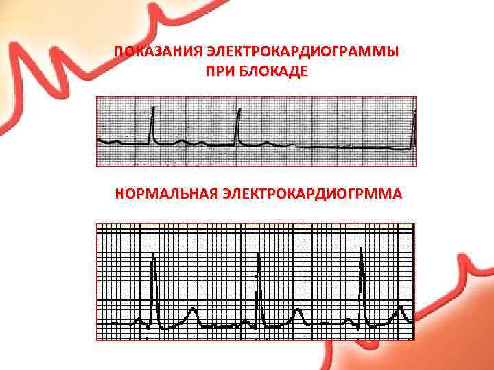 ПОКАЗАНИЯ ЭЛЕКТРОКАРДИОГРАММЫ ПРИ БЛОКАДЕ НОРМАЛЬНАЯ ЭЛЕКТРОКАРДИОГРММА 