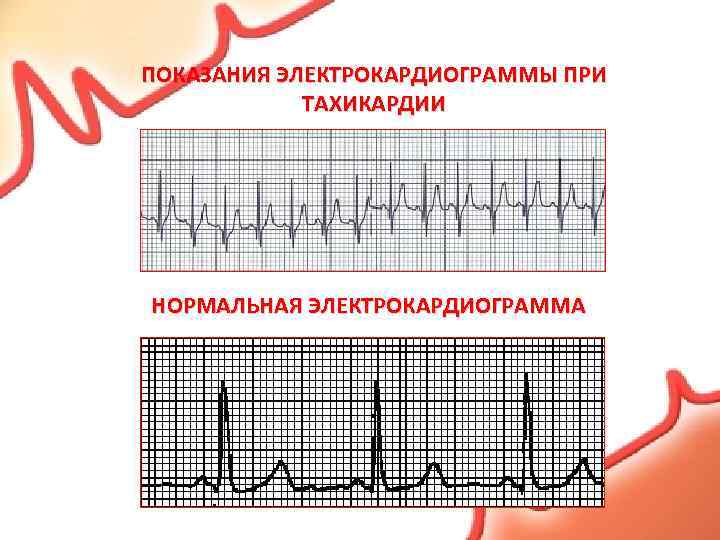 ПОКАЗАНИЯ ЭЛЕКТРОКАРДИОГРАММЫ ПРИ ТАХИКАРДИИ НОРМАЛЬНАЯ ЭЛЕКТРОКАРДИОГРАММА 