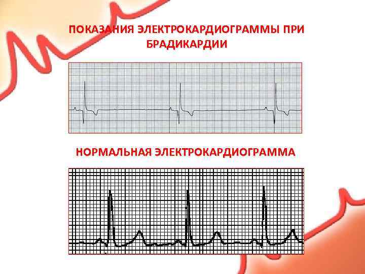 ПОКАЗАНИЯ ЭЛЕКТРОКАРДИОГРАММЫ ПРИ БРАДИКАРДИИ НОРМАЛЬНАЯ ЭЛЕКТРОКАРДИОГРАММА 