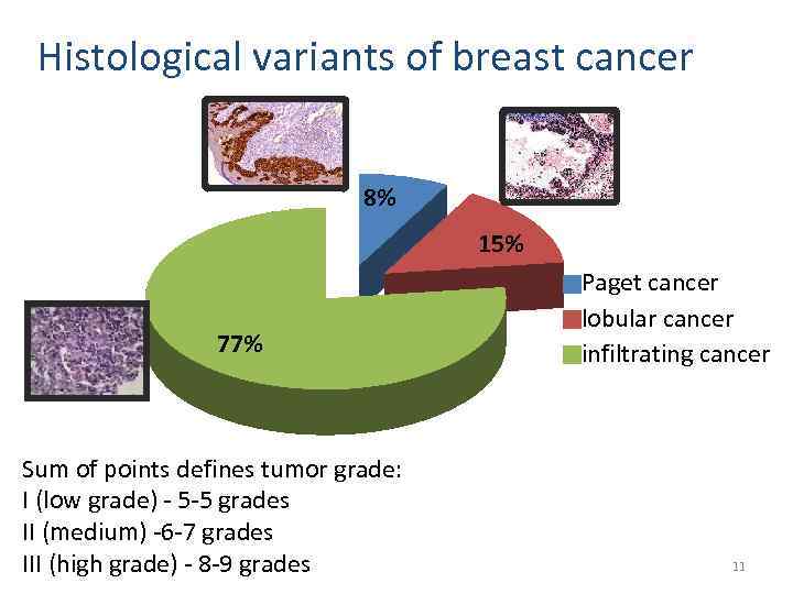 Histological variants of breast cancer 8% 15% 85% 77% Sum of points defines tumor