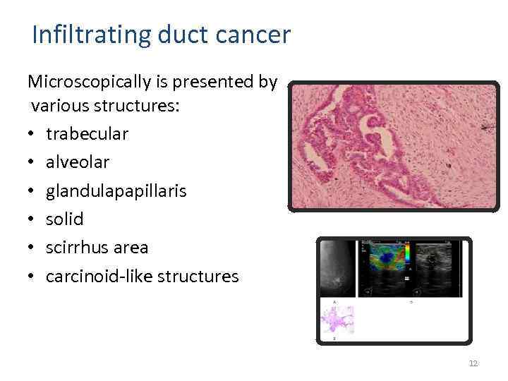 Infiltrating duct cancer Microscopically is presented by various structures: • trabecular • alveolar •
