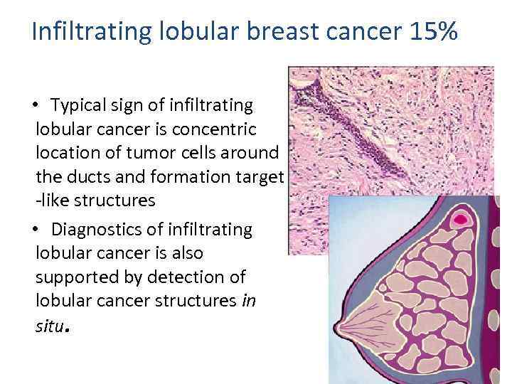 Infiltrating lobular breast cancer 15% • Typical sign of infiltrating lobular cancer is concentric