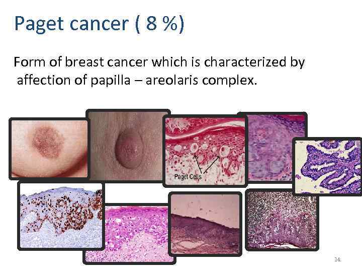 Paget cancer ( 8 %) Form of breast cancer which is characterized by affection