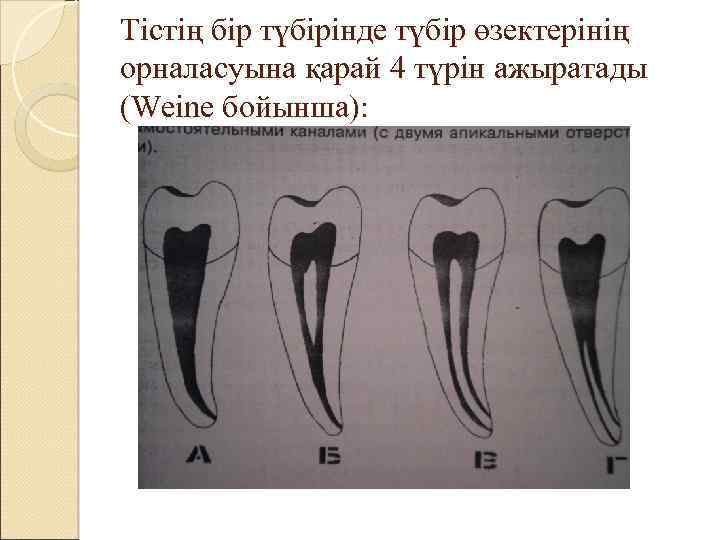 Тістің бір түбірінде түбір өзектерінің орналасуына қарай 4 түрін ажыратады (Weine бойынша): 