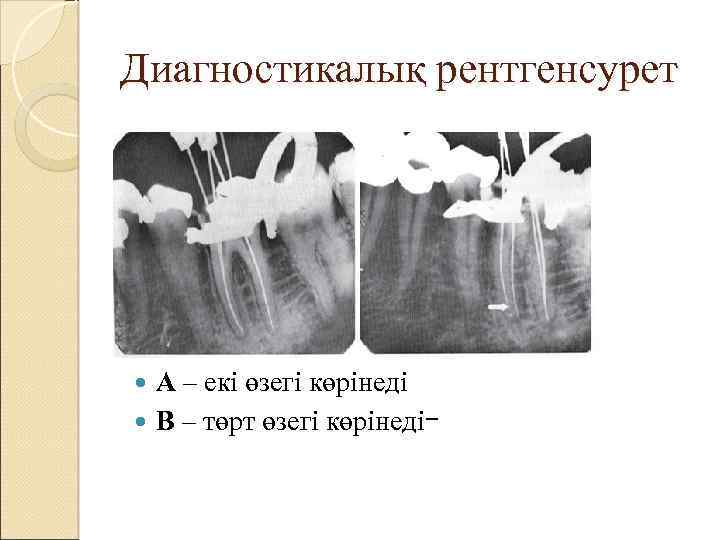 Диагностикалық рентгенсурет А – екі өзегі көрінеді В – төрт өзегі көрінедіｰ 
