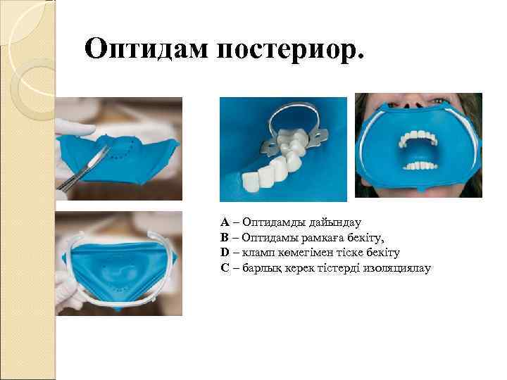 Оптидам постериор. А – Оптидамды дайындау B – Оптидамы рамкаға бекіту, D – кламп