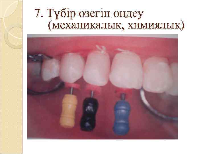 7. Түбір өзегін өңдеу (механикалық, химиялық) 