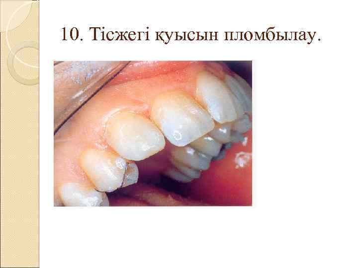 10. Тісжегі қуысын пломбылау. 