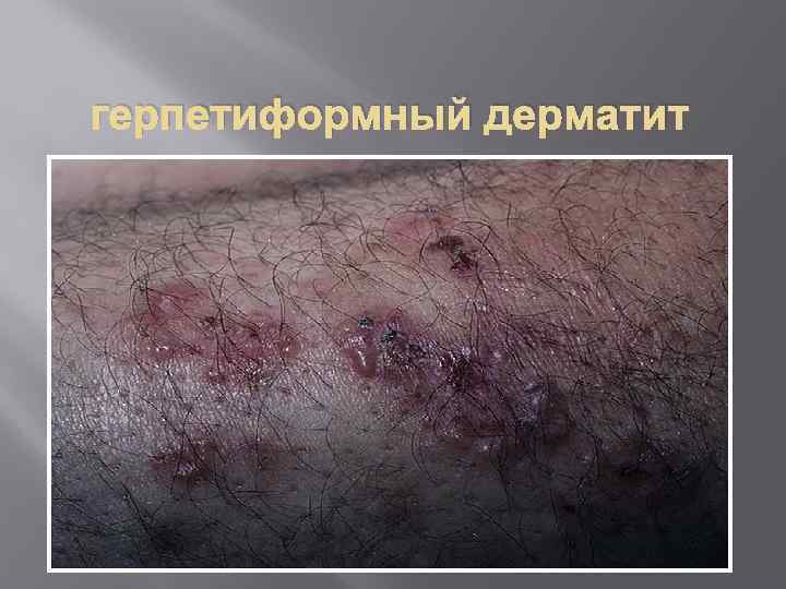 герпетиформный дерматит 