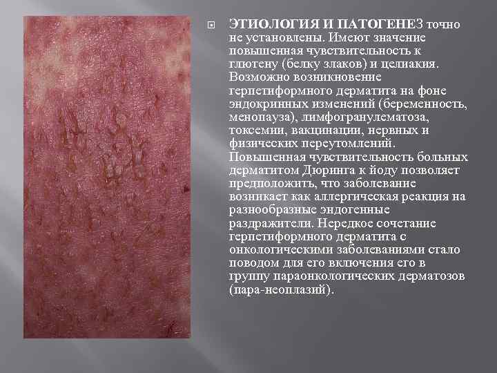  ЭТИОЛОГИЯ И ПАТОГЕНЕЗ точно не установлены. Имеют значение повышенная чувствительность к глютену (белку