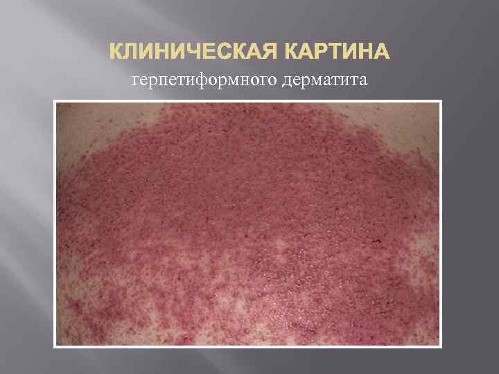 герпетиформного дерматита 