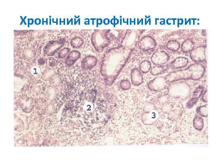 Хронічний атрофічний гастрит: 