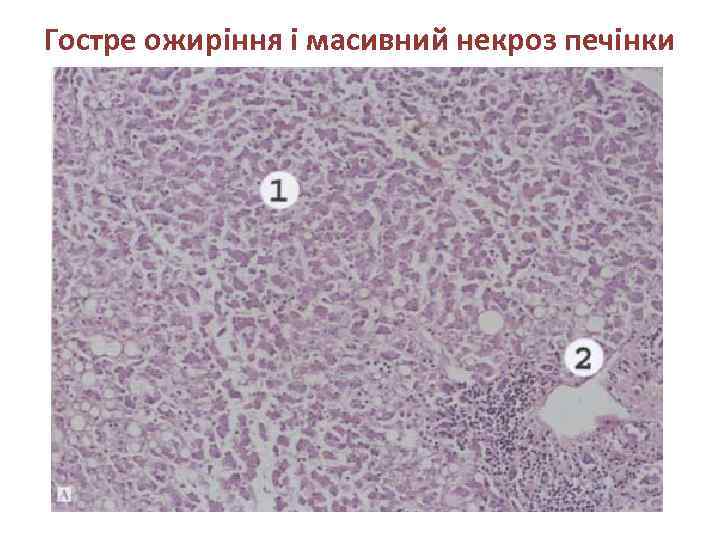 Гостре ожиріння і масивний некроз печінки 