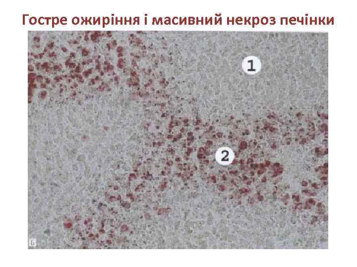 Гостре ожиріння і масивний некроз печінки 