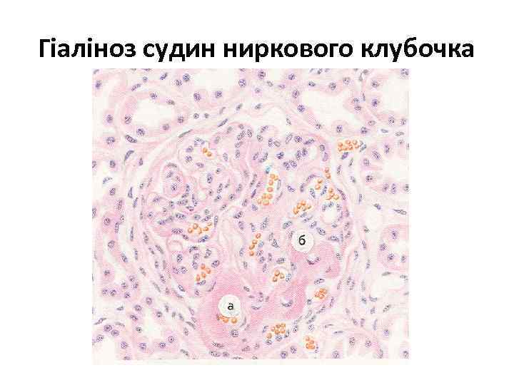 Гіаліноз судин ниркового клубочка 
