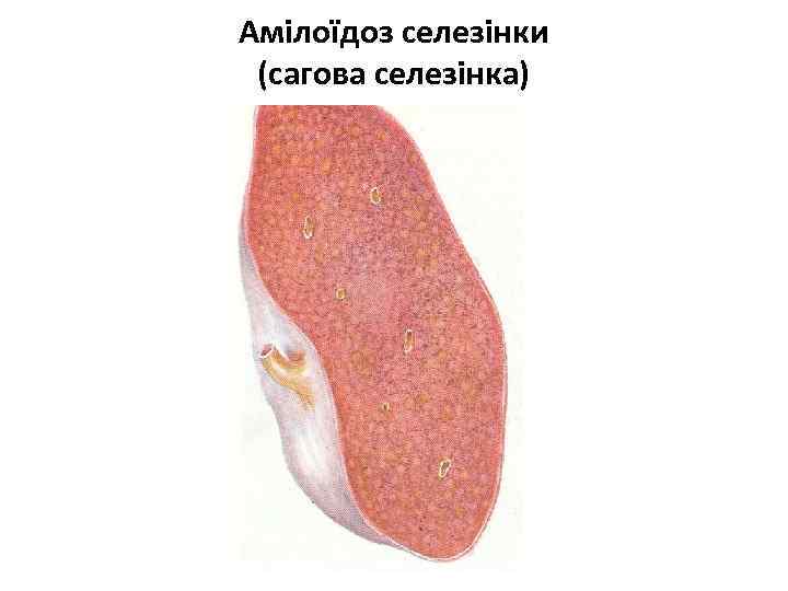 Амілоїдоз селезінки (сагова селезінка) 