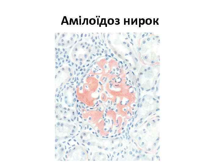 Амілоїдоз нирок 