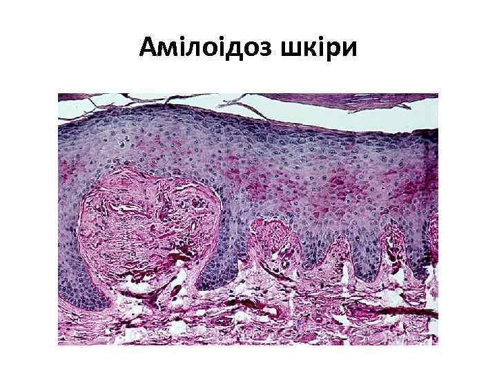 Амілоідоз шкіри 