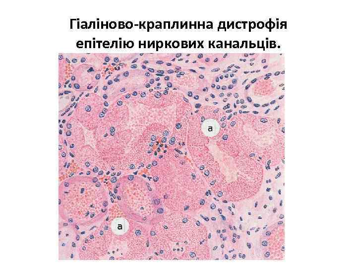 Гіаліново-краплинна дистрофія епітелію ниркових канальців. 