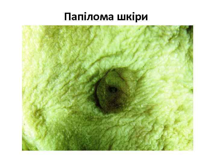 Папілома шкіри 