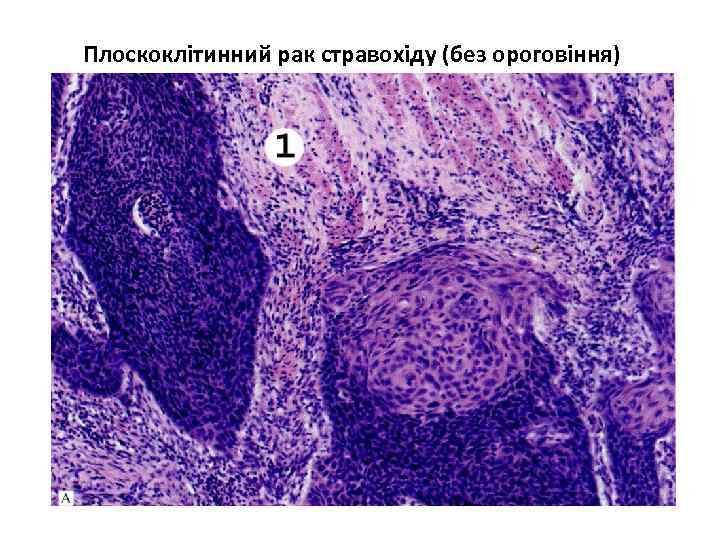 Плоскоклітинний рак стравохіду (без ороговіння) 