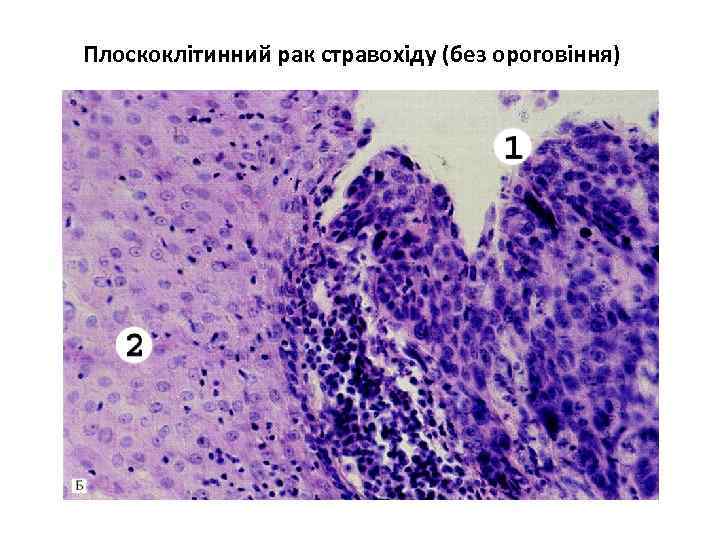 Плоскоклітинний рак стравохіду (без ороговіння) 