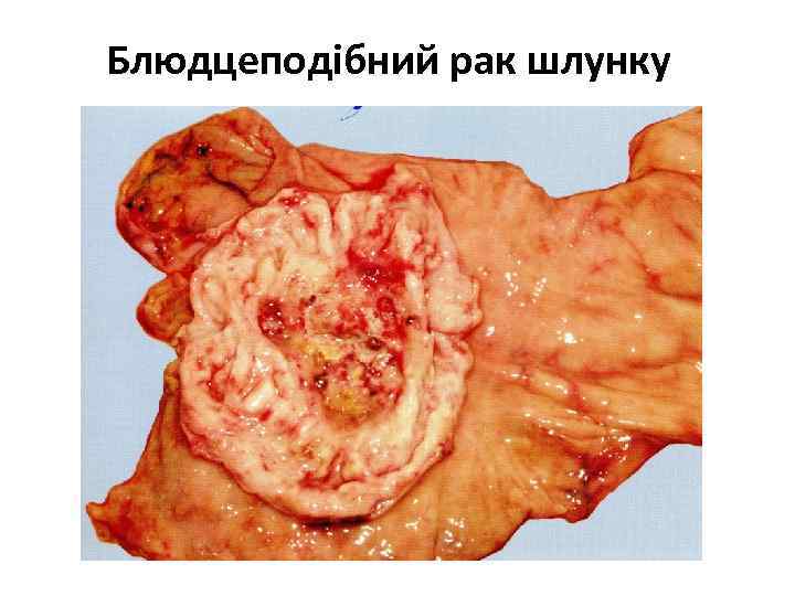Блюдцеподібний рак шлунку 