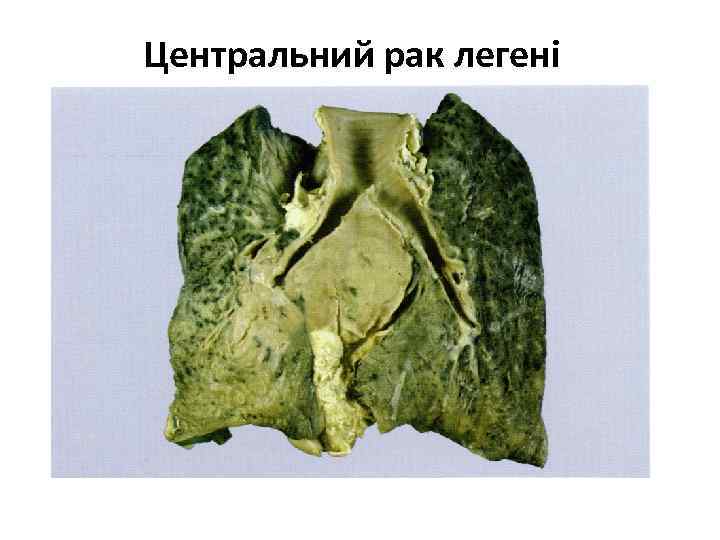 Центральний рак легені 