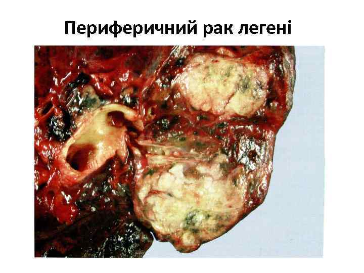 Периферичний рак легені 