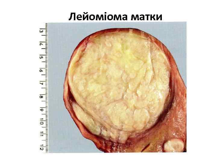 Лейоміома матки 