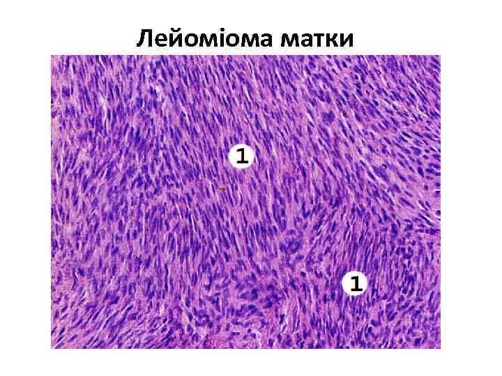 Лейоміома матки 