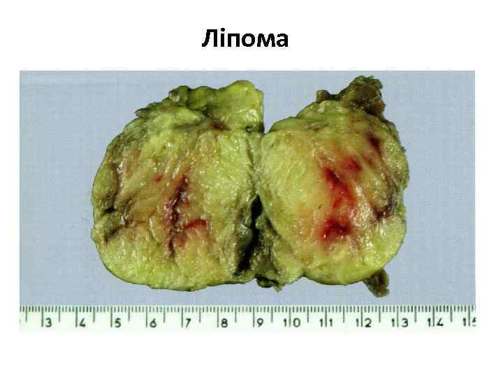 Ліпома 