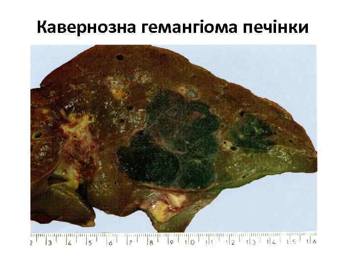 Кавернозна гемангіома печінки 